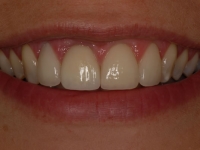 After smile - 3 veneers and a dental crown