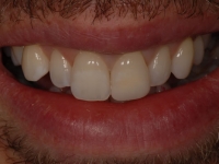 After smile - Professional tooth whitening and a white front tooth restoration filling